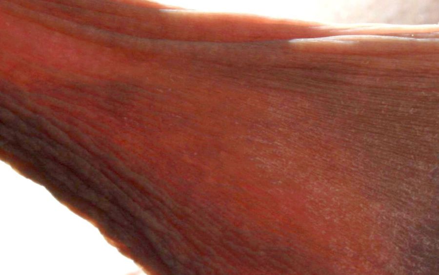Full labia length from a woman with hypertrophy labia minora.